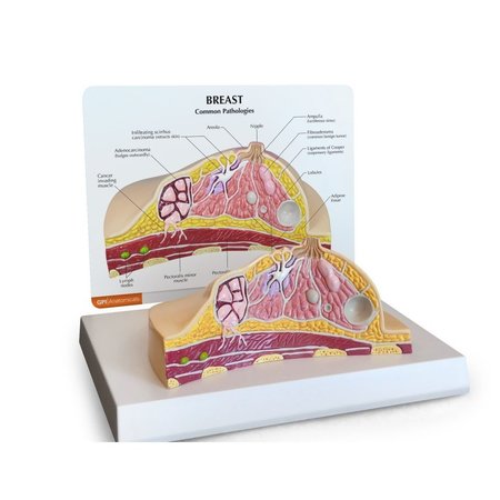 GPI ANATOMICAL Anatomical Model - Breast - Cancer 3450